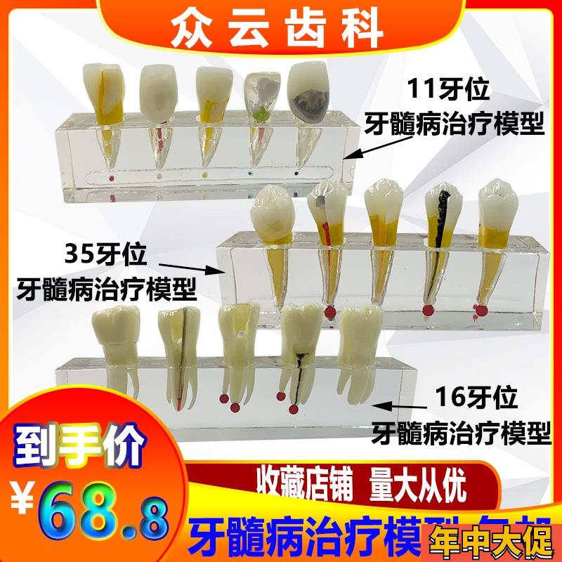 牙科口腔牙髓病治疗模型解t剖前磨牙龋坏牙冠髓腔充填可拆牙列模