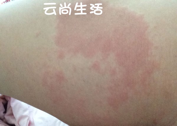 大腿内侧发红治头癣头部牛皮藓癣头皮屑真菌感染剂洗发水毛膏炎银