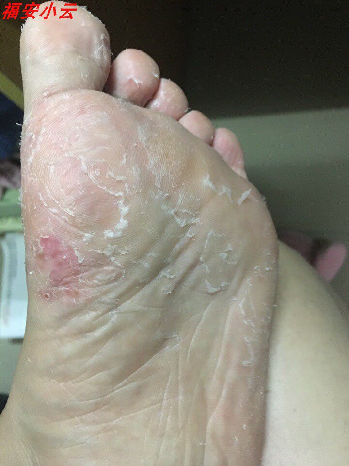 去癣神器脚气膏红痒天下康 快多邦软膏皮肤过敏止痒清疹蚊软药膏