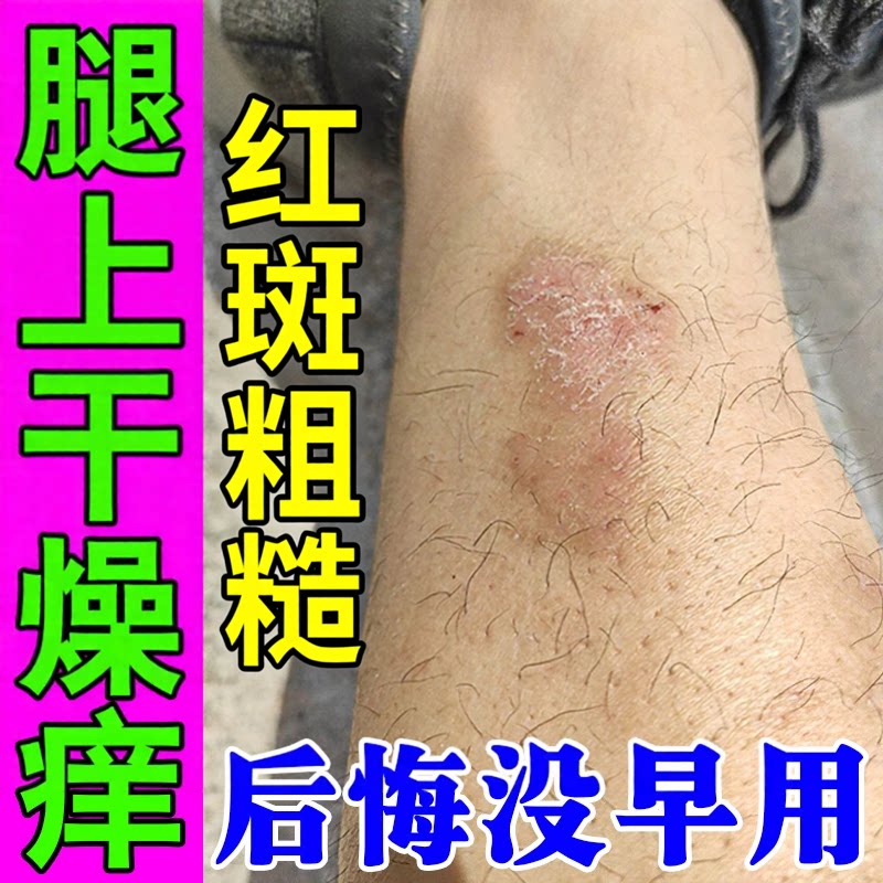 腿上长红斑腿部发痒小腿干燥起皮很痒红疙瘩神经性皮肤痒专用乳膏