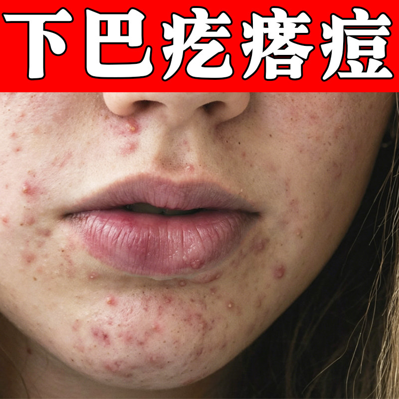 下巴长痘痘修复红肿脓包疙瘩红痒痘内分泌失调按压疼痛改善粗糙痘