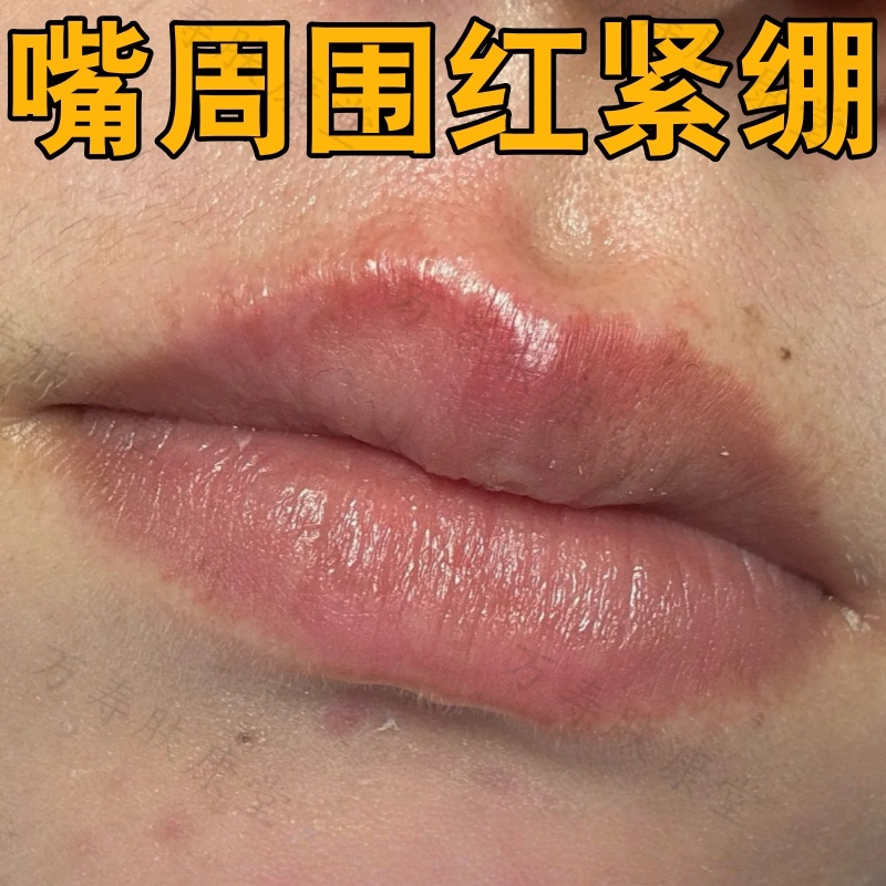 嘴周围红干燥紧绷脱屑性唇部皮肤炎羊胡子疮红肿胀痛唇膏补水保湿