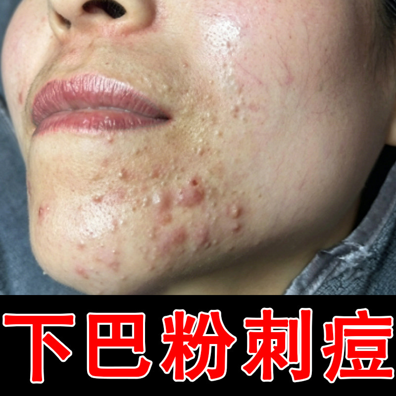 下巴痘痘护理腮边连痘经期冒痘皮下凸起颗粒毛孔堵塞出油长痘软膏