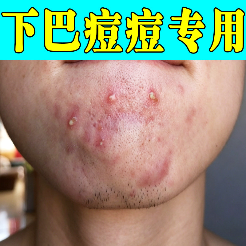 下巴痘痘护理下颌闭口疙瘩生理期爆痘表层泛红油脂旺盛毛孔堵塞痘