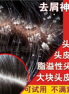 妙芳颂治疗去屑毛囊炎头痒洗发水