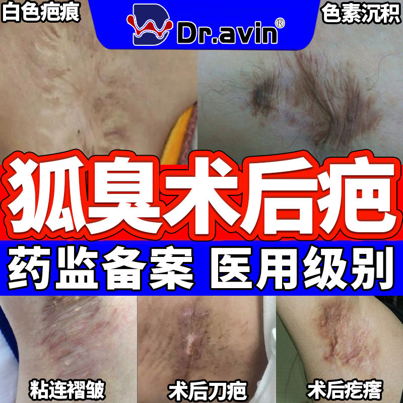 腋下狐臭手术引起疤痕疙瘩增生凸起恢复贴术后硅凝胶疤膏去除BF
