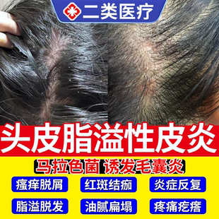 头皮屑脂溢性皮炎真菌感染头癣喷剂毛囊炎搭专用洗发水去屑止痒ON
