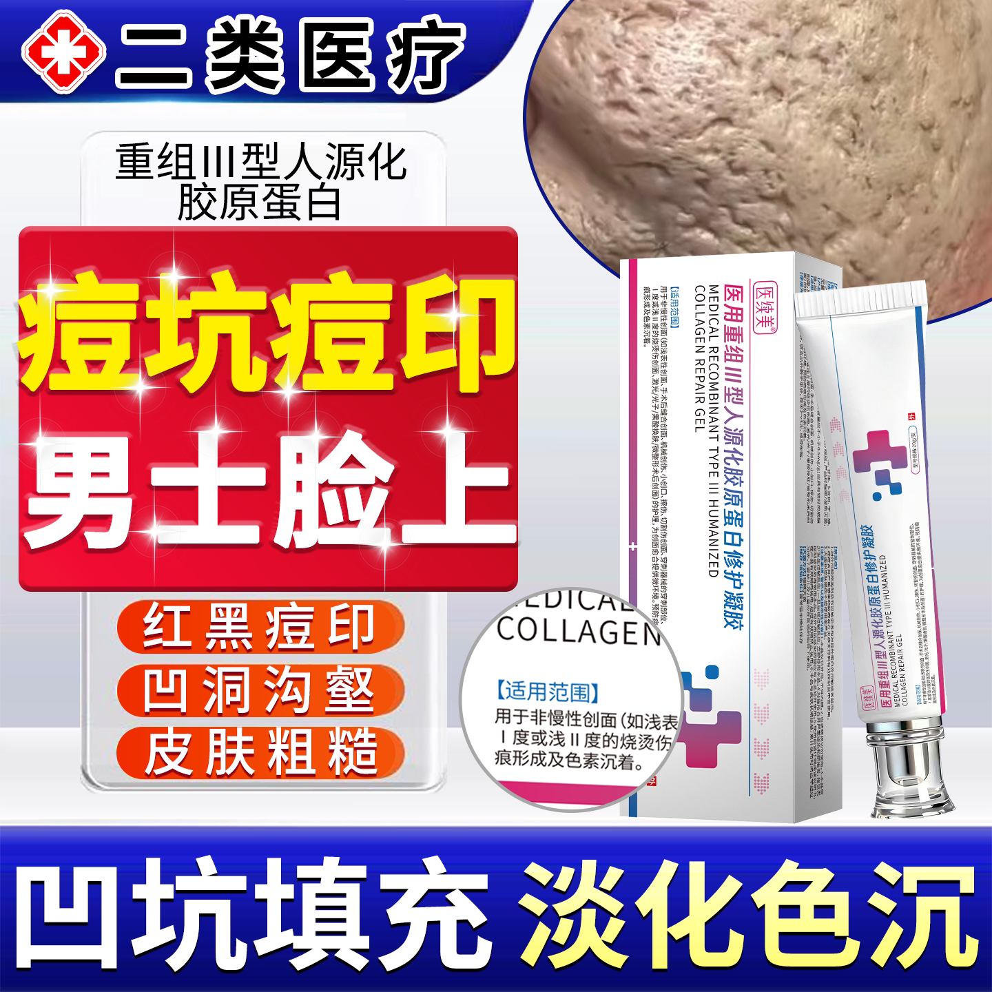 痘印痘坑凹洞修复男士医用型淡化填充祛去痘疤消炎黑印色素沉淀YY