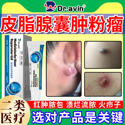 皮脂腺囊肿拔毒膏针消粉瘤火疖子疖肿硬块拔脓去除搭专用膏药贴YU