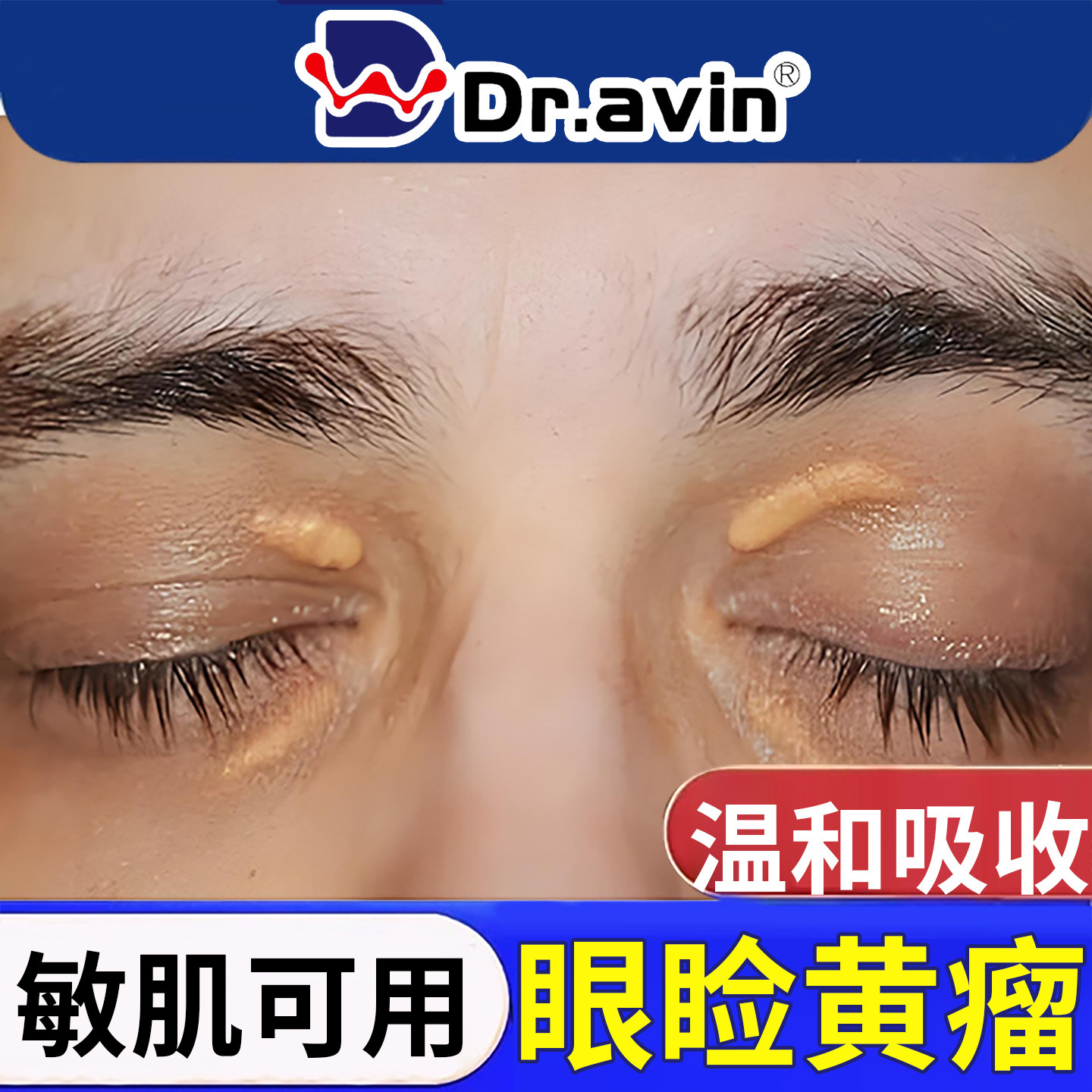 眼睑黄瘤去眼皮黄斑瘤专用去除神器眼角脂肪粒睑黄疣搭膏药贴YU