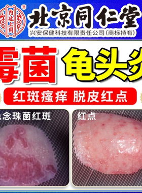 男性龟头炎专用症真菌感染霉菌性喷剂男性专用私处上有小红点Y