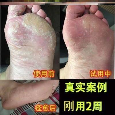 贵州神奇珊瑚癣净250ml泡脚脚臭止痒脱皮