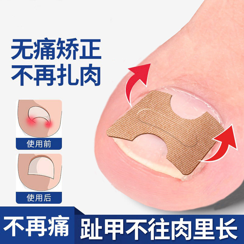 正甲贴甲沟垫片嵌甲专用指甲矫正器卷甲脚沟炎脚趾甲往肉里长神器