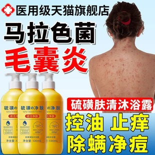 马拉色菌毛囊炎医用背上长痘痘沐浴露除螨祛痘痒硫磺软膏前胸后背