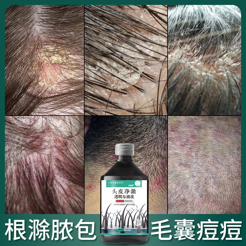 头皮毛囊炎专用头部头上长痘痘痒有疙瘩洗头膏洗发水去屑止痒中药
