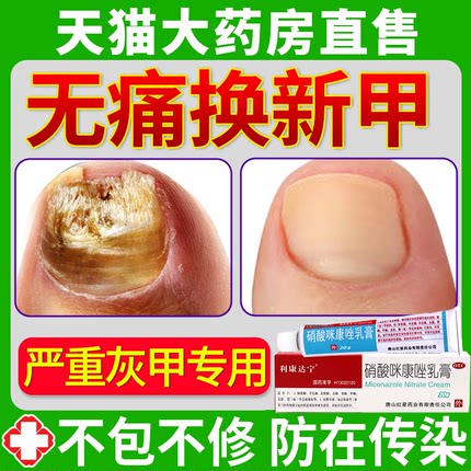 治疗灰指甲药膏正品旗舰店专用非盐酸啊阿莫罗芬搽剂非特效水DHYP