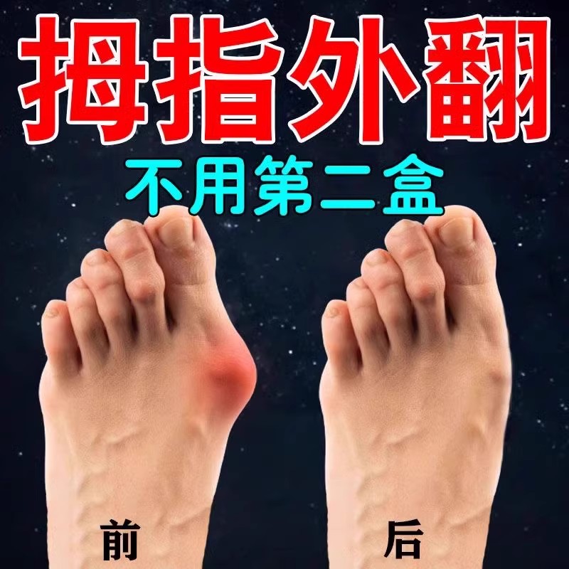拇指外翻矫正器大脚骨关节胀痛专用膏贴脚趾重叠突出畸形神器膏药