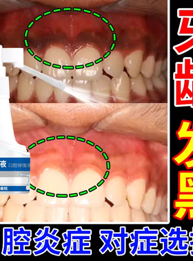 牙龈变黑牙周炎色素沉着上火脓包漱口水重度牙龈肿痛发黑喷雾TU