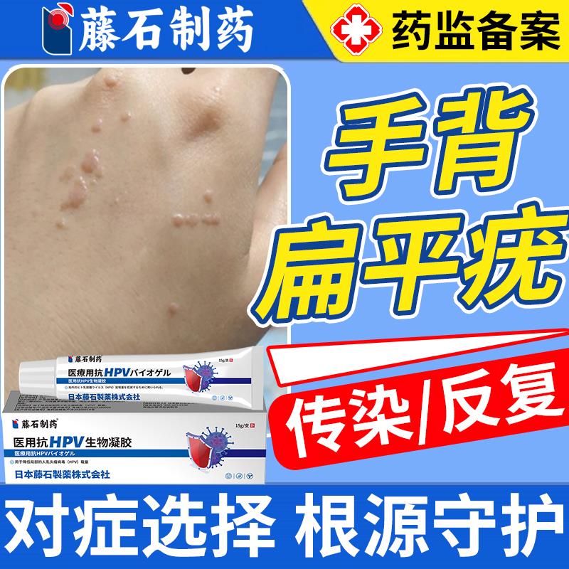 去手背上扁平疣专用除膏一
