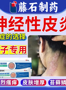 脖子上神经性皮炎瘙痒去祛顽固根长癣痒除止痒喷雾剂贴外用膏WQ
