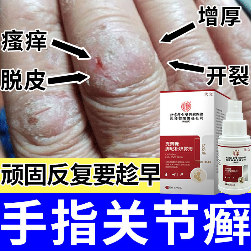 手指关节癣手癣膏脱皮干裂真菌感染湿疹专可搭配膏药贴用中KV