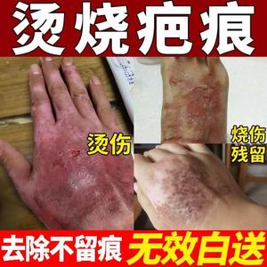 烫伤去疤膏烧伤疤痕修复油去黑印色素沉淀祛疤膏除疤正品修复膏