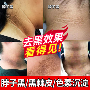 脖子黑色素去除颈部美白霜儿童脖子黑黑的黑棘皮沉淀去黑药膏神器