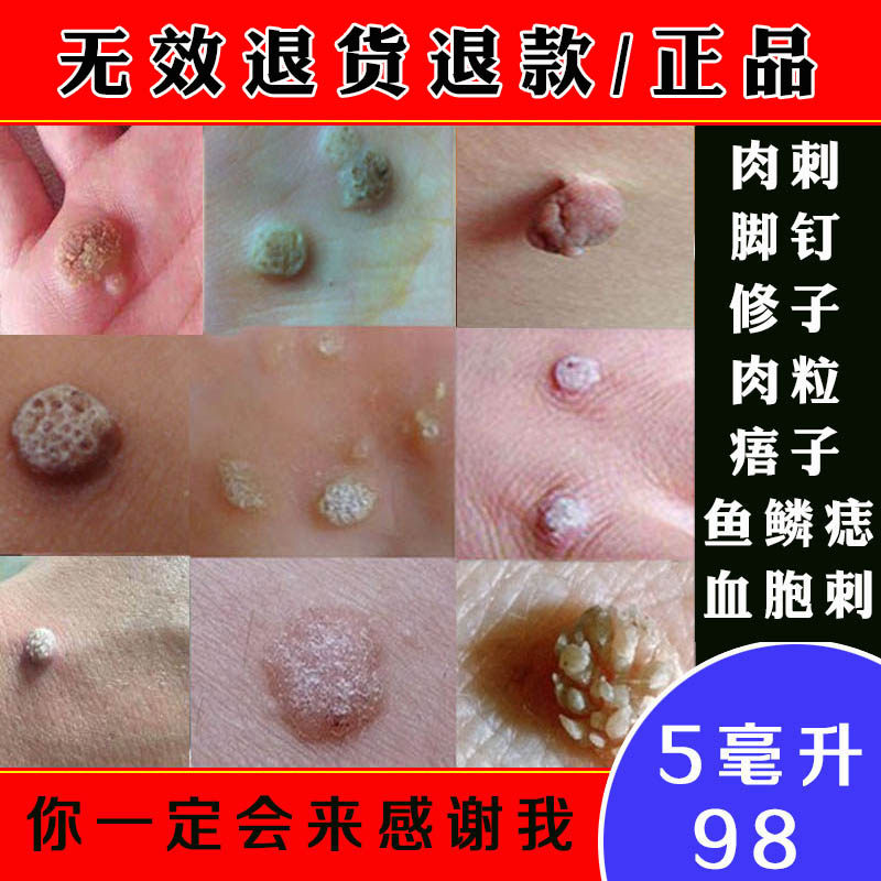 治鱼鳞痣专用脚肉刺去除膏瘊的药修子贴血胞刺祛跖神器候子修子贴