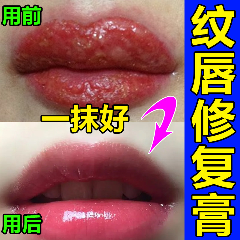 纹唇后的专用修复精华飘唇去肿固色锁色润唇膏做唇不结痂修复液剂