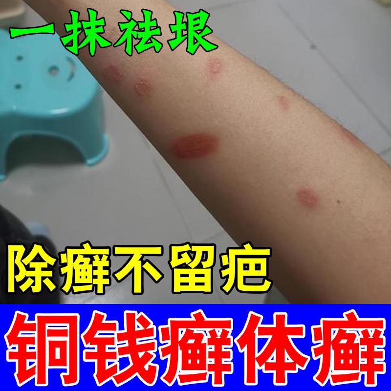 铜钱癣体癣专用药膏猫癣人用外用痒止金钱手肘铜钱藓牛皮癣头癣药