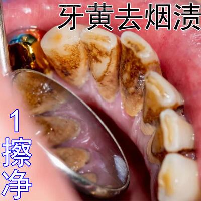 【白牙神器】牙菌斑祛除神器去黄牙黑牙结石烟渍牙垢医用牙齿美白