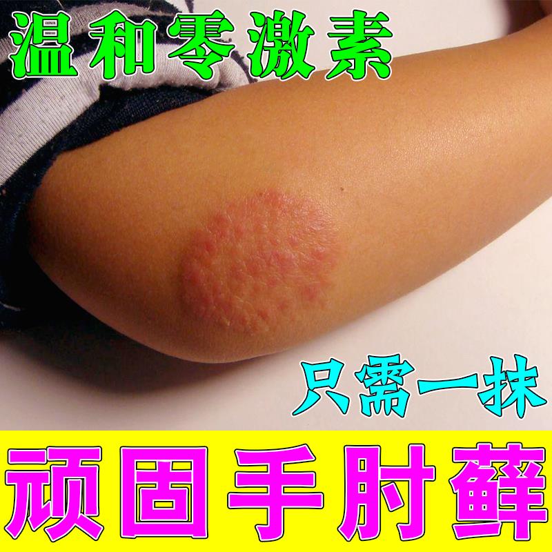 手肘癣关节胳膊顽固皮藓身上起红斑肘关节藓瘙痒手臂脖子止痒乳膏