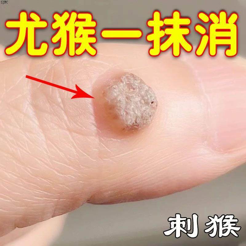 跖疣净老茧贴尤猴瘊疣脚底老茧去除手指鱼眼贴止优舒跖疣水杨酸