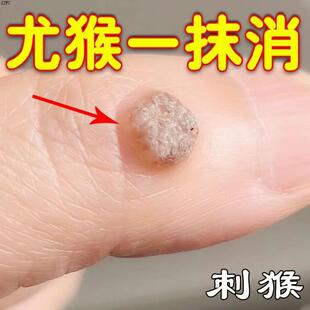 跖疣净老茧贴尤猴瘊疣脚底老茧去除手指鱼眼贴止优舒跖疣水杨酸