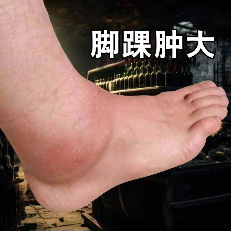 脚腕疼痛专用药脚踝肿大胀崴脚扭伤积水积液脚脖子走路疼消肿化瘀