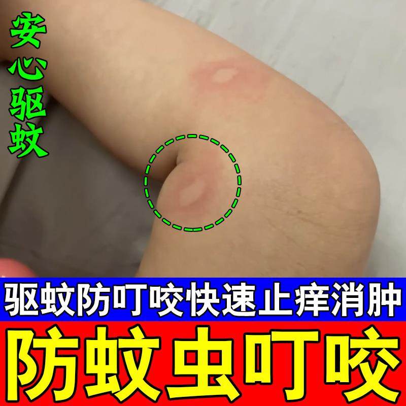 止痒膏蚊虫叮咬螨虫叮咬药膏蚂蚁咬伤药膏红火蚁隐翅虫毒虫跳蚤叮