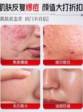 SXCS透明质酸钠凝胶+3%水杨酸控油膏舒缓补水嫩肤肤