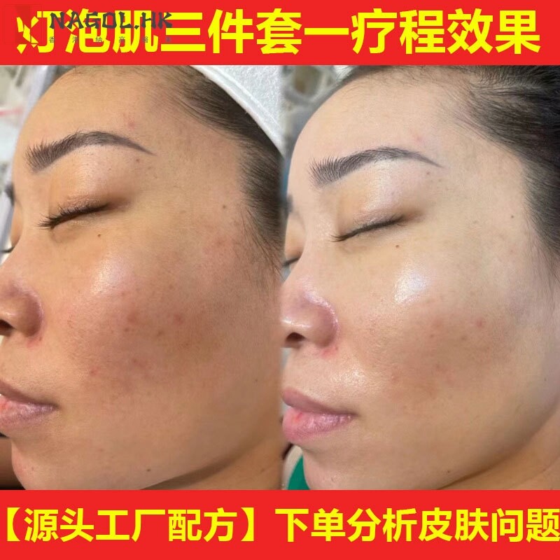 美容院灯泡肌调肤液套装打造素颜肌肤去黑色素去黄提亮美白精华液