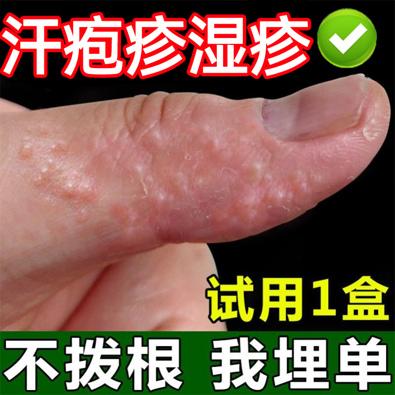 手上起小水泡汗状疱疹止痒汗泡药膏鹅掌风特效药真菌感染手气膏 畜牧/养殖物资 动物保健品 原图主图