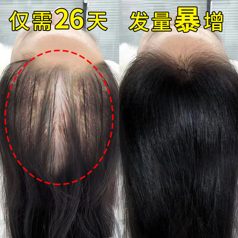 【防脱发】自然生长头发自然生长速度 男女头发速度变密 仅次植发