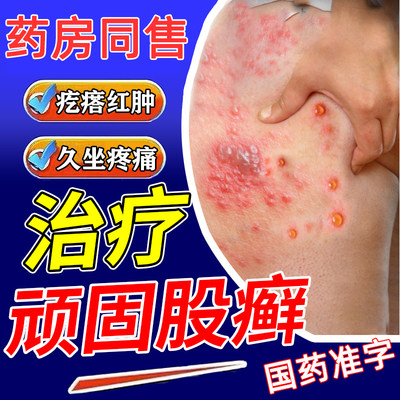 去股藓药膏大腿内侧真菌感染皮肤治瘙痒私处止痒根男士湿疹特效md