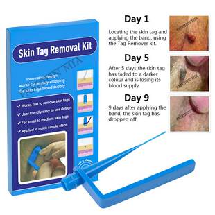 Blue Set Skin Tag Removal Kit Home Use Mole Wart Remover Equ