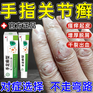 手指关节癣手癣膏脱皮干裂关节增厚出血真菌感染湿疹瘙痒专用膏WY