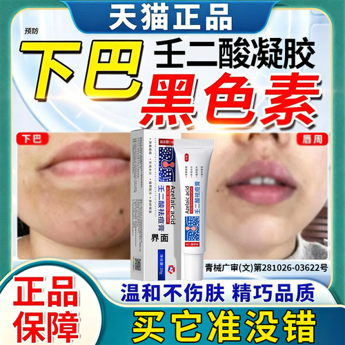 脸上黑斑去除分解黑色素壬二酸乳膏去下巴暗沉改善唇周黑淡痘印YB