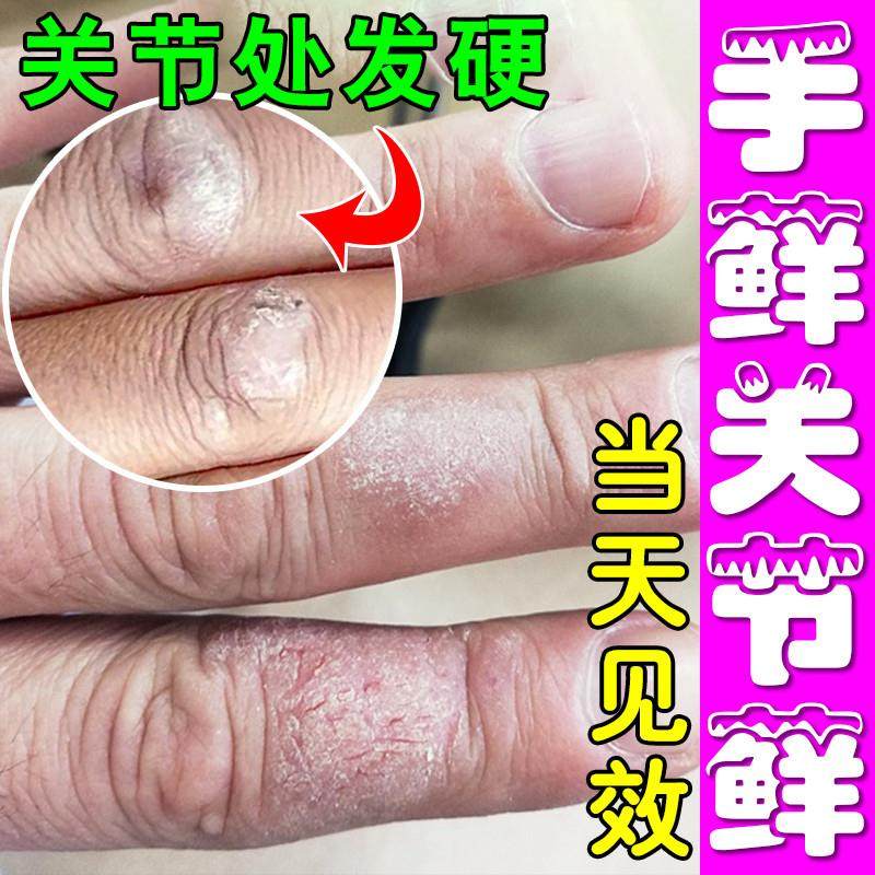 手指关节癣真菌感染手关节长硬疙瘩茧红肿瘙痒脱皮干裂抑菌手藓膏