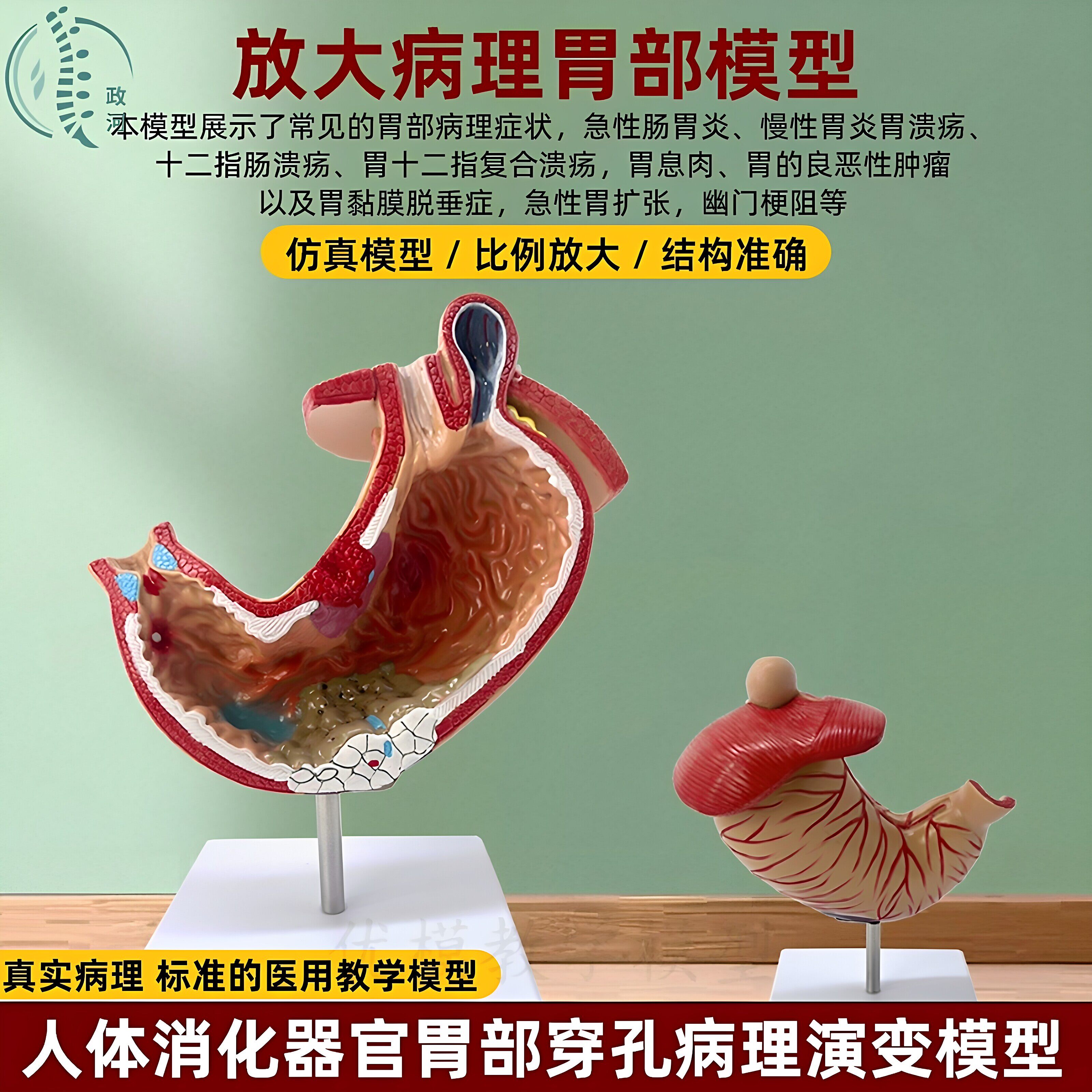 政河人体胃部穿孔病理解剖模型胃炎息肉溃疡医用教学演示仿真教具