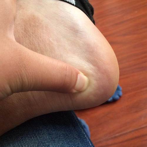 30年经验专注足跟痛！护脚