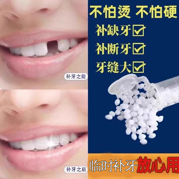 补牙齿补牙缝洞膏树脂儿童老蛀牙材料牙洞填补膏牙缝修复宽大神器