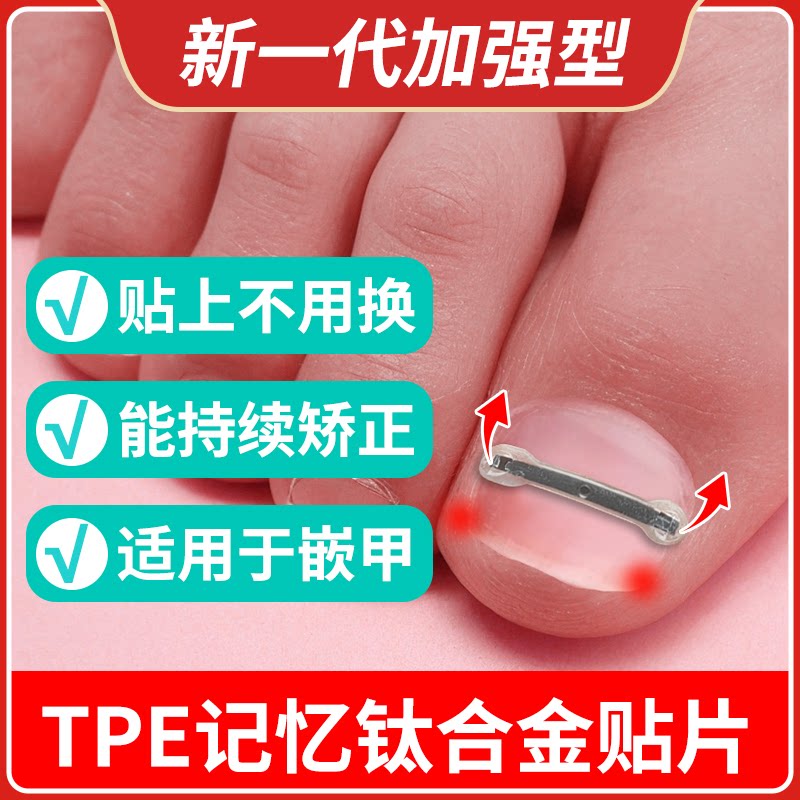 钛合金正甲贴甲沟嵌甲炎拉拉脚指甲趾甲专用矫正器纠正贴片长肉里