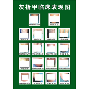 定制印刷脚气灰指甲的危害广告图医院皮肤科宣传画知识大海报制作